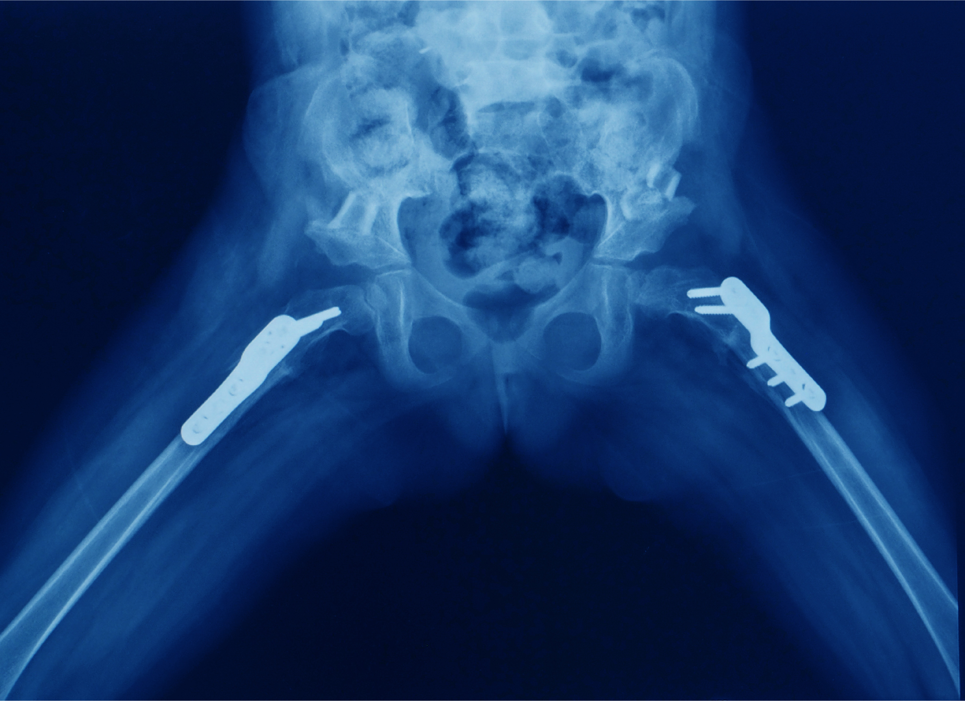 socal-kids-femur-fracture