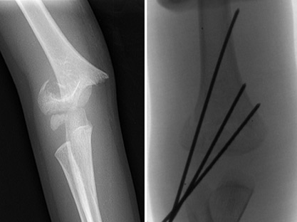 socal-kids-elbow-fracture