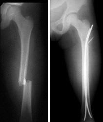 socal-kids-femur-fracture