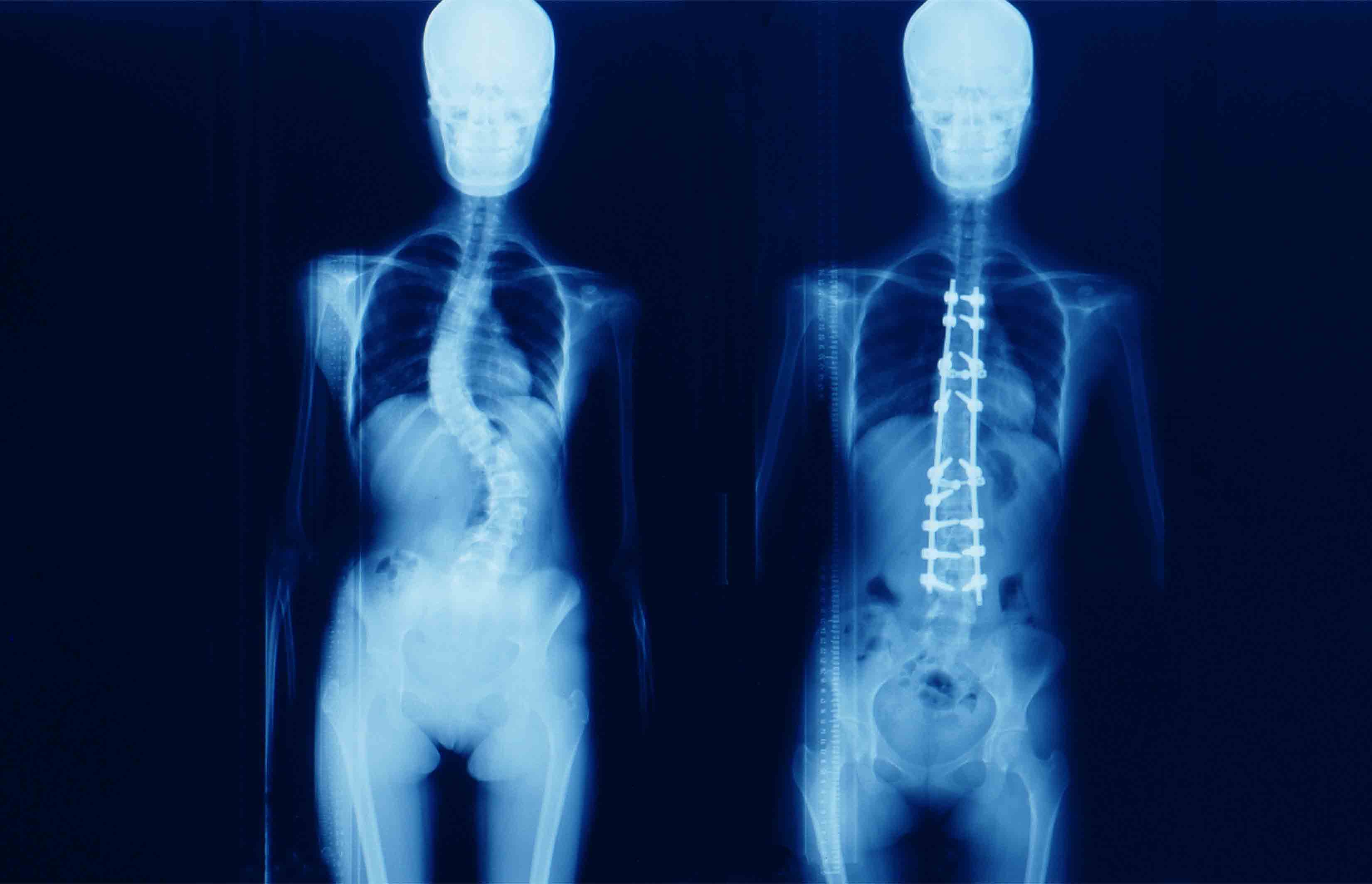 socal-kids-femur-fracture